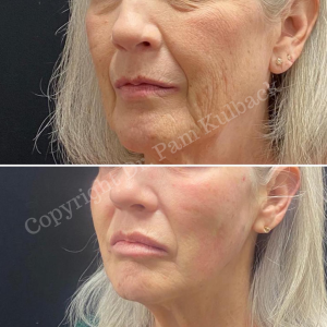 Read more about the article CoolPeel™ Top Skin Resurfacing Laser