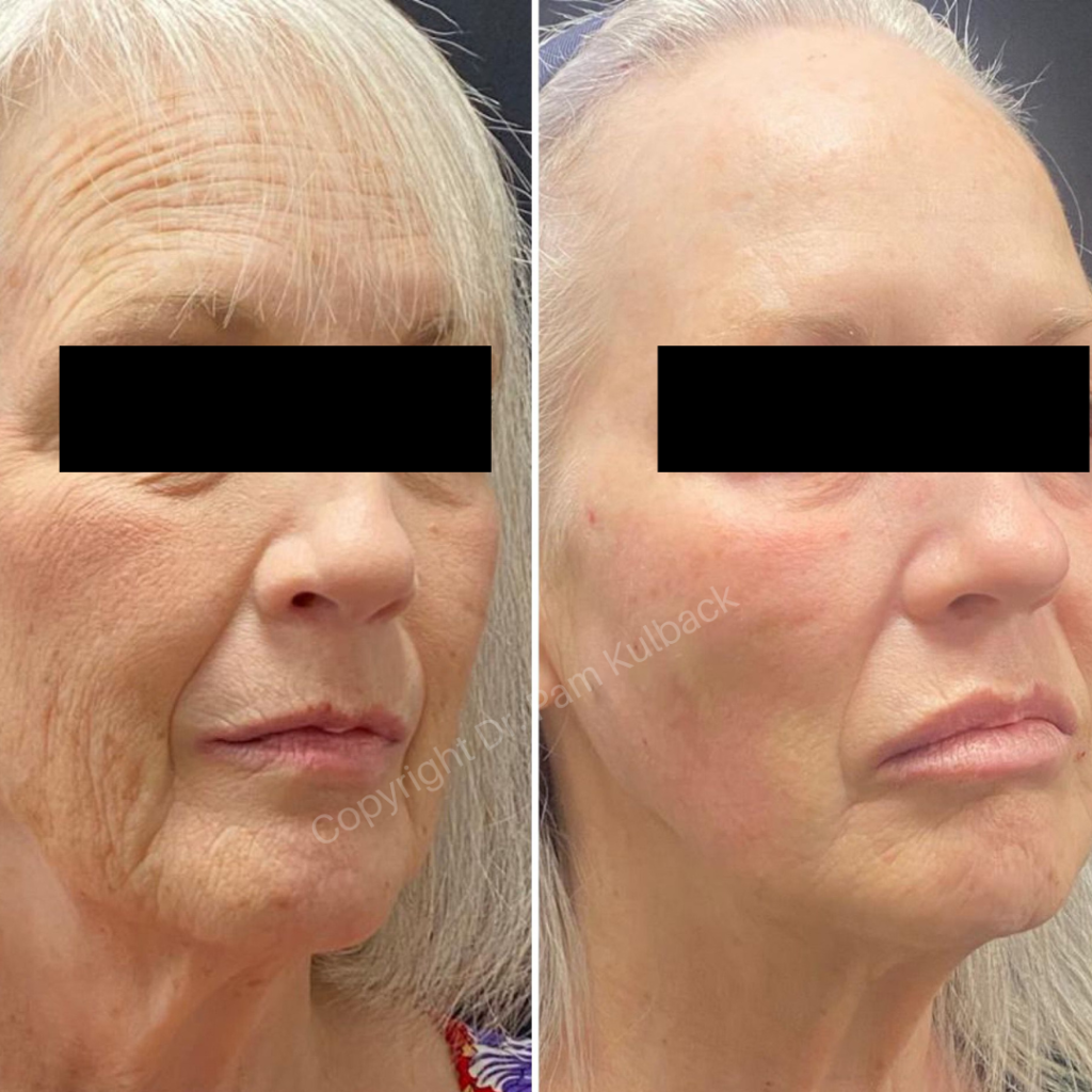 Before and after 4-months of Combination Skin Therapy. Patient received Virtue RF + CoolPeel and IPL, Sculptra, Restylane Kysse to the lips, Dysport , and PDO Thread-Facelift by Dr. Pamela Kulback