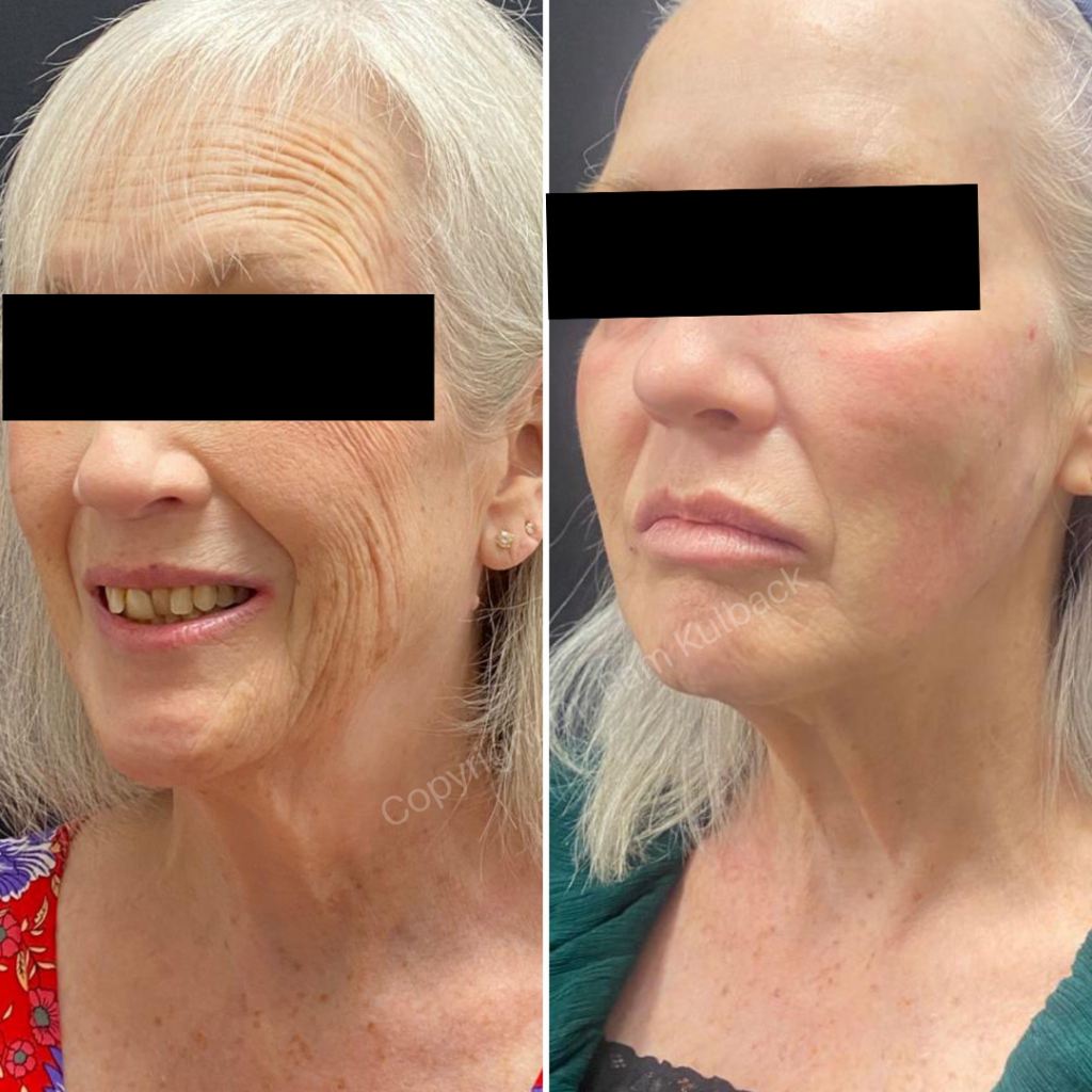 Before and after 4-months of Combination Skin Therapy. Patient received Virtue RF + CoolPeel and IPL, Sculptra, Restylane Kysse to the lips, Dysport , and PDO Thread-Facelift by Dr. Pamela Kulback