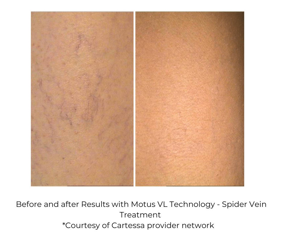 Before and after Results with Motus VL Technology - Spider Vein Treatment *Courtesy of Cartessa provider network
