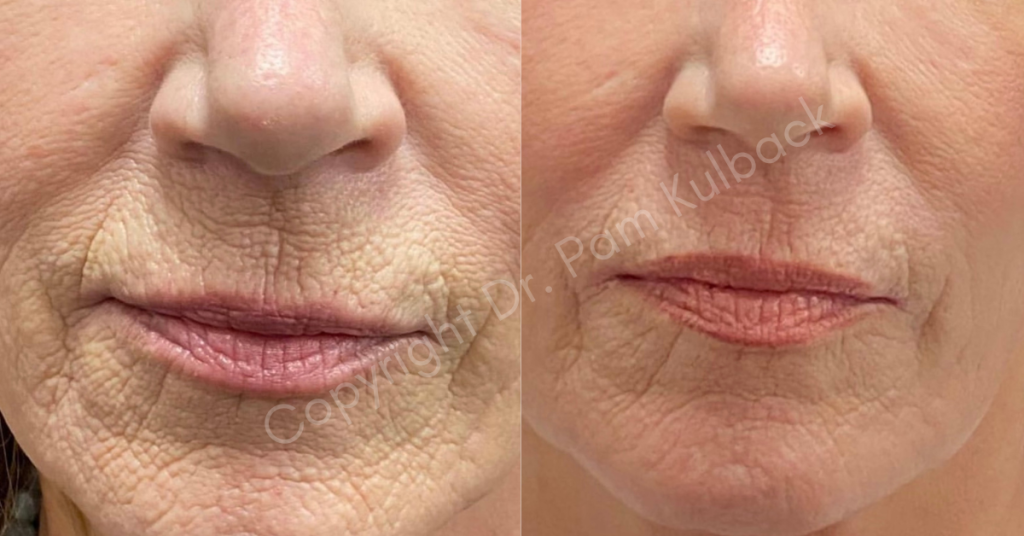 CO2 Laser Skin Resurfacing