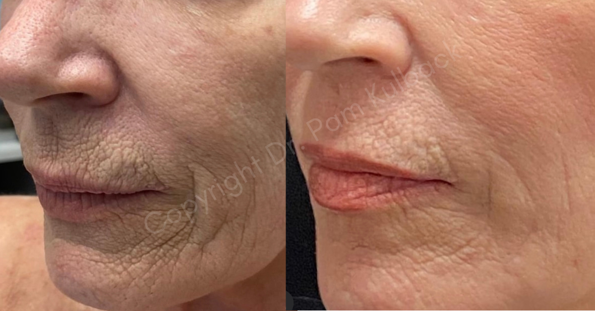 Before and after CoolPeel Subnovii and Virtue RF