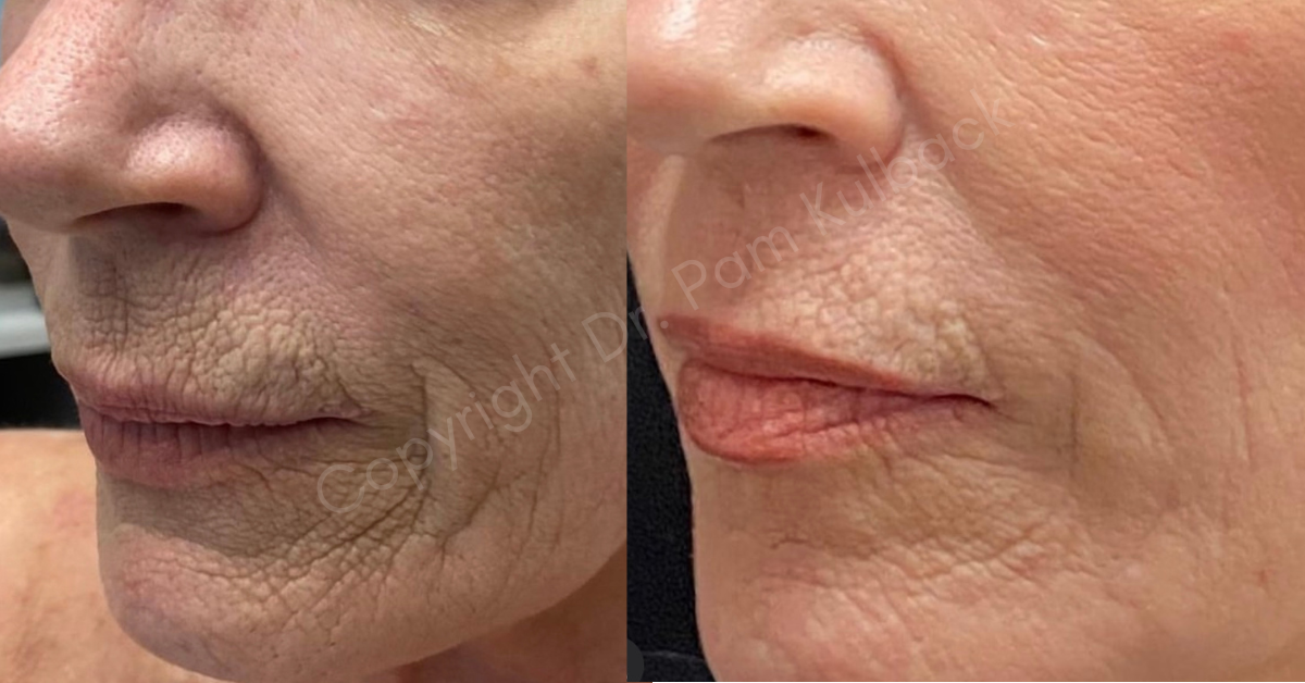 Tetra Co2 Laser And Coolpeel™ The Latest In Laser Skin Resurfacing