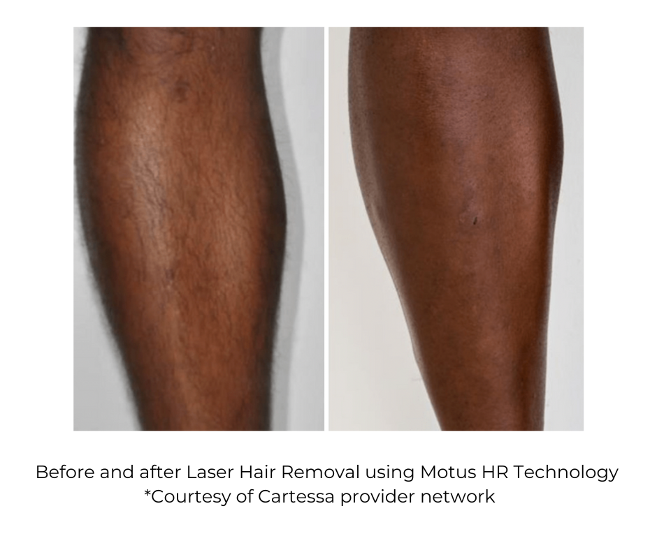 Before and after Laser Hair Reduction using Moveo HR Technology