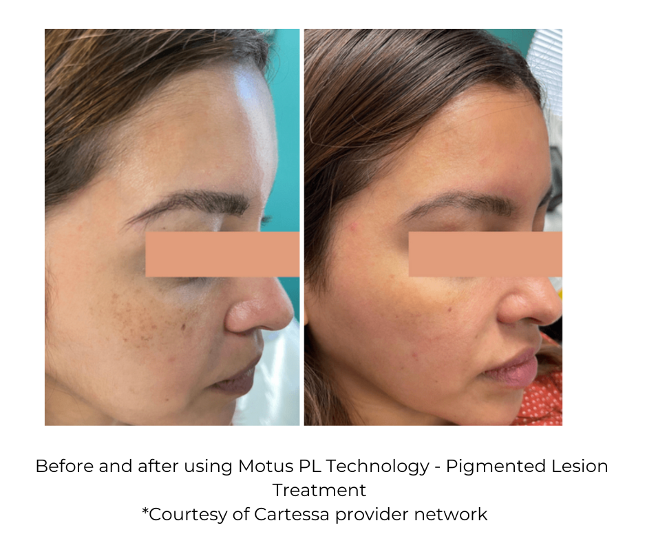 Before and after Moveo PL setting for pigmented lesion reduction *Courtesy of Cartessa Provider Network