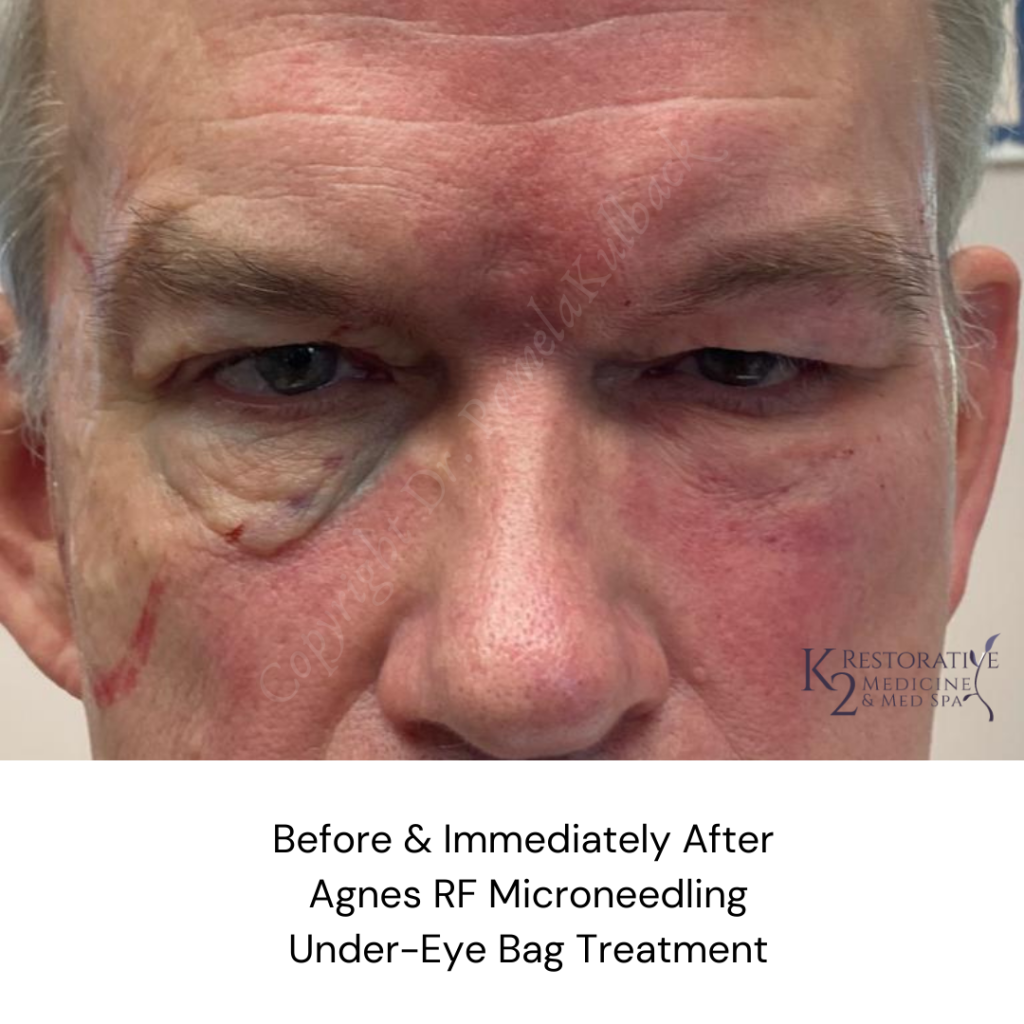 Before and Immediately after Agnes RF Microneedling - Under Eye Bag Treatment