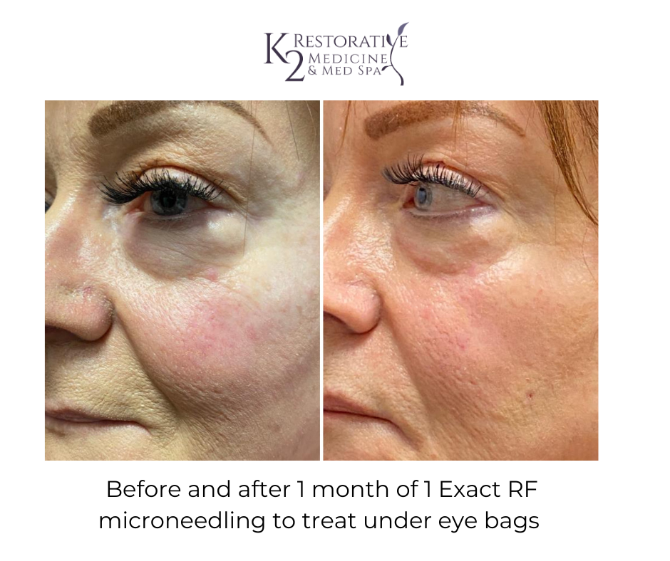 Before and After 1 Month of 1 Exact RF Microneedling to treat under eye bags