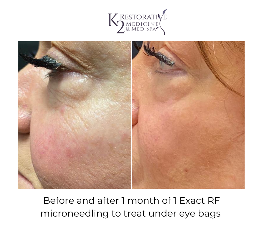 Before and After 1 Month of 1 Exact RF Microneedling to treat under eye bags