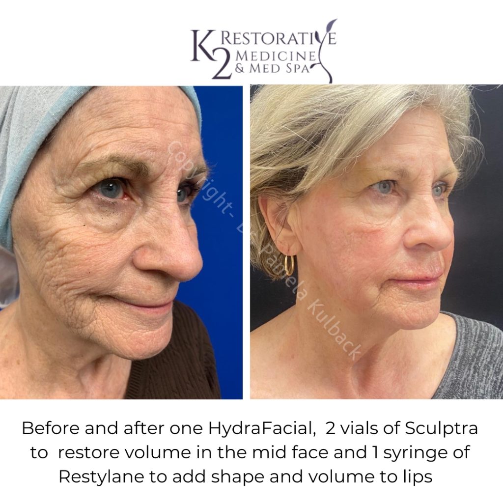 Before and After Hydrafacial, 2 Vials of Sculptra to restore volume in mid face and 1 syringe of Restylane to add shape and volume to lips