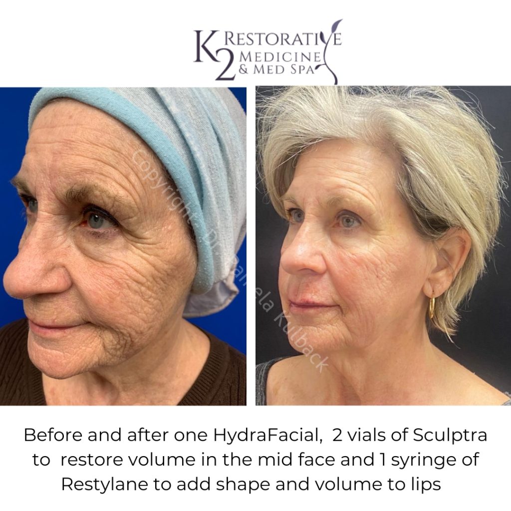 Before and After Hydrafacial, 2 Vials of Sculptra to restore volume in mid face and 1 syringe of Restylane to add shape and volume to lips