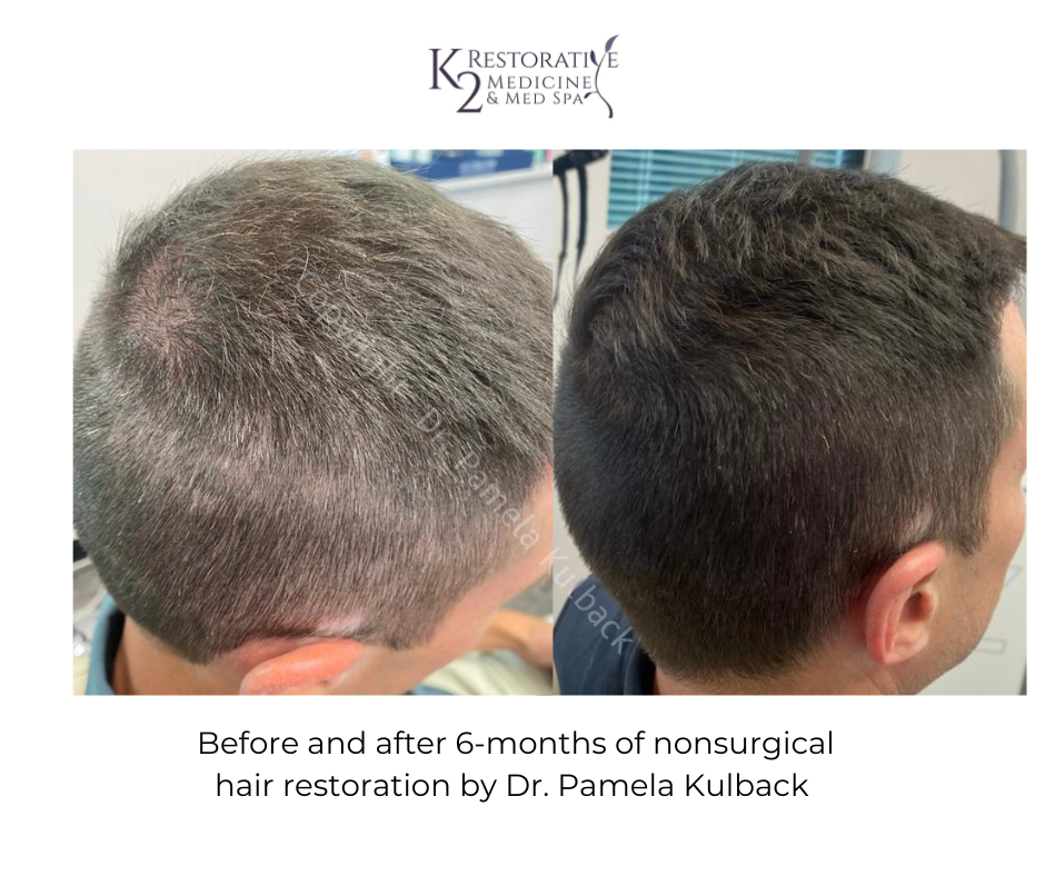 Before and after nonsurgical hair restoration
