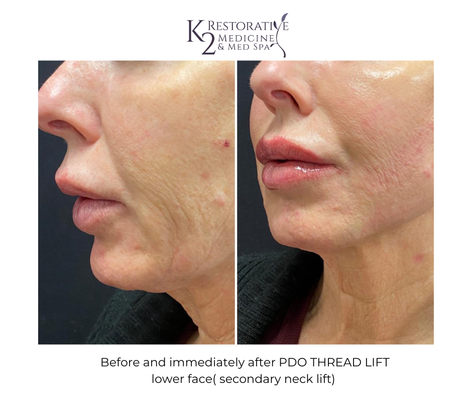 Before and immediately after PDO Thread lift