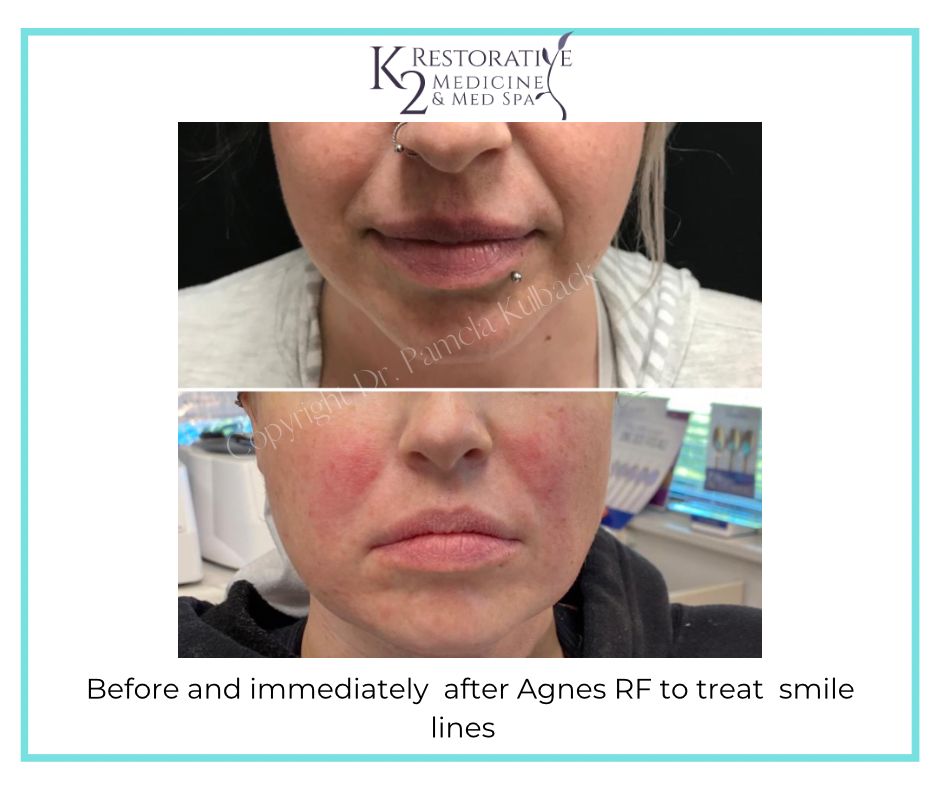 Before and Immediately after Agnes RF to treat Smile lines