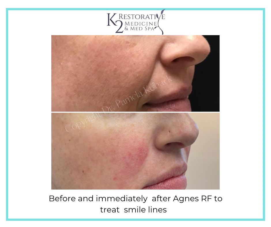 Before and immediately after Agnes RF to treat smile lines - K2 Restorative