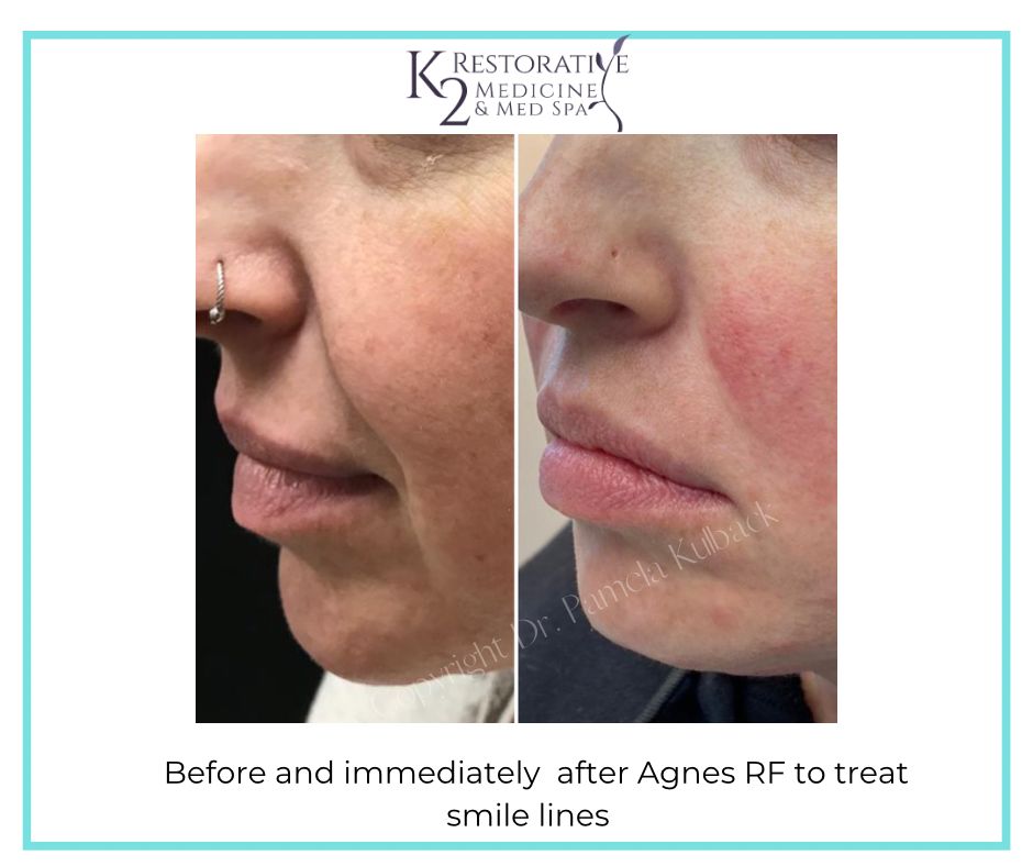 Amazing Before and After Results of Agnes RF to treat smile Lines
