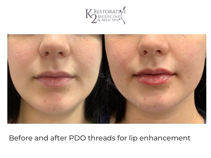 Before and After PDO Threads for lip Enhancement by Dr Pamela Kulback