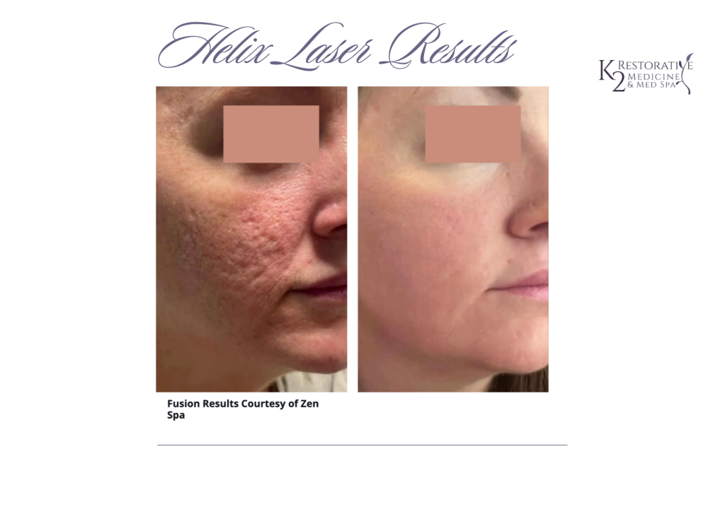 Helix-laser-skin-resurfacing at K2 Medicine