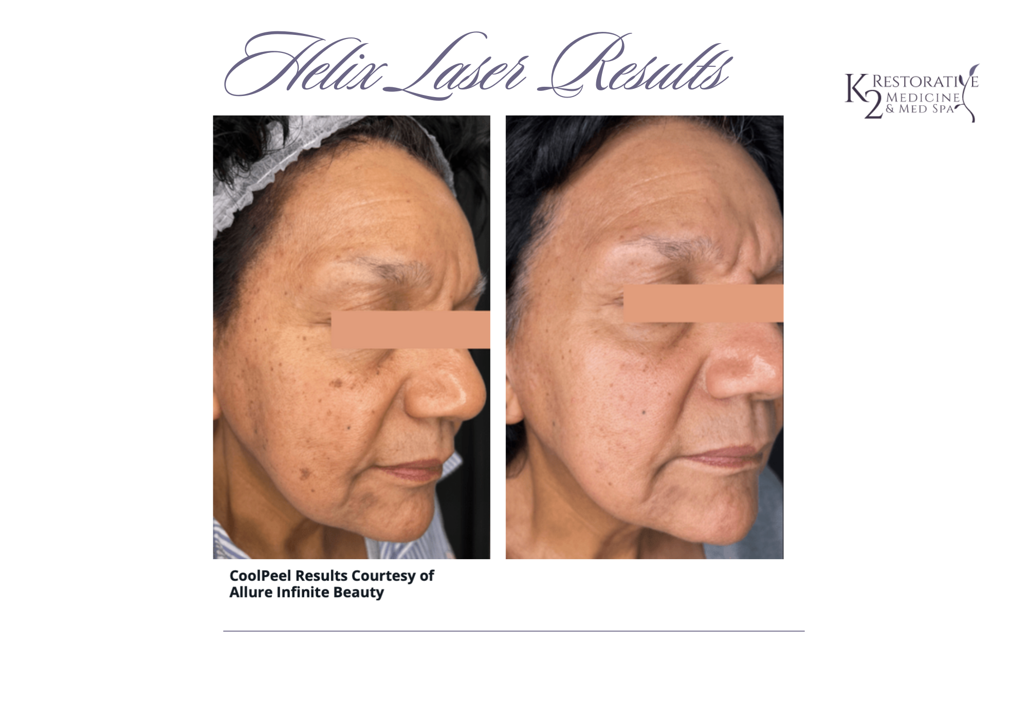 Helix Laser Resurfacing Results at K2 Medicine