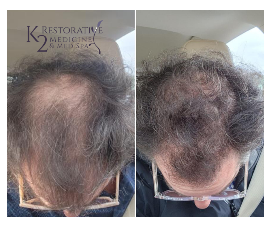 Before and after 3 Derive treatments for hair restoration