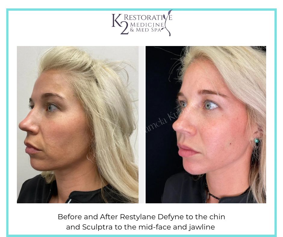 Before and After Restylane Defyne to the chin and Sculptra to the mid-face and jawline