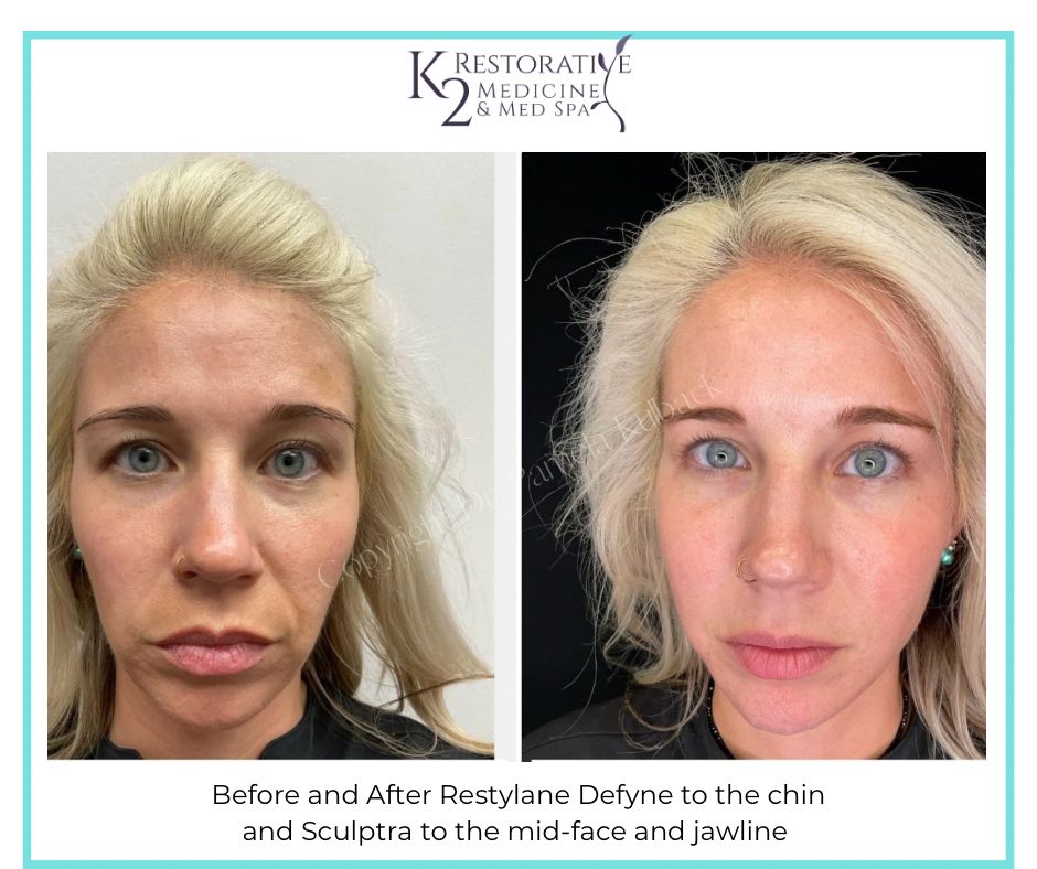 Before-and-After-Restylane-Defyne-to-the-chin-and-Sculptra-to-the-mid-face-and-jawline