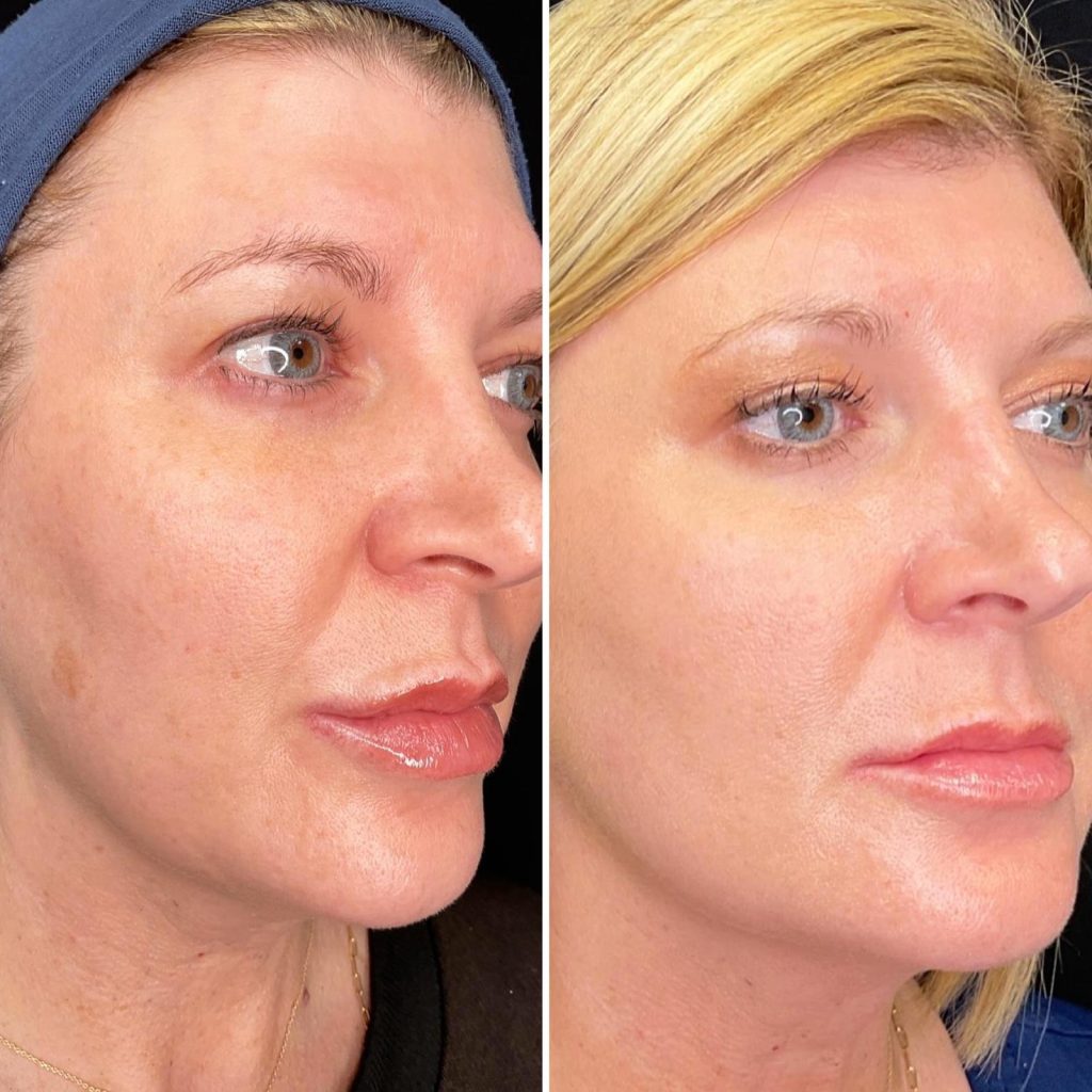 Before and after 3 months of Subnovii Plasma Pen treatment for a sunspot on the right cheek.
