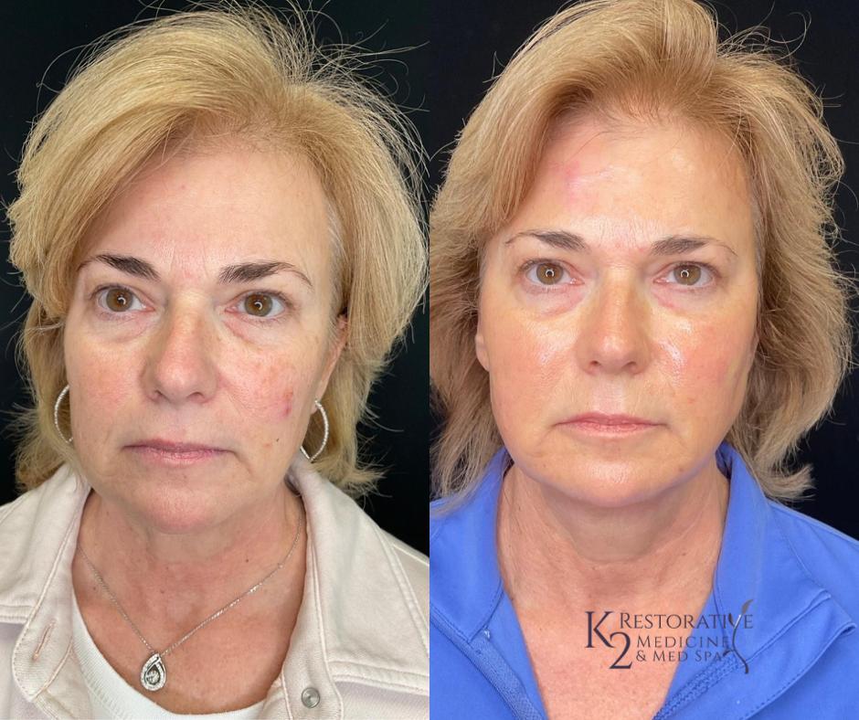 Before and After Sculptra Treatment at K2 medicine and med spa