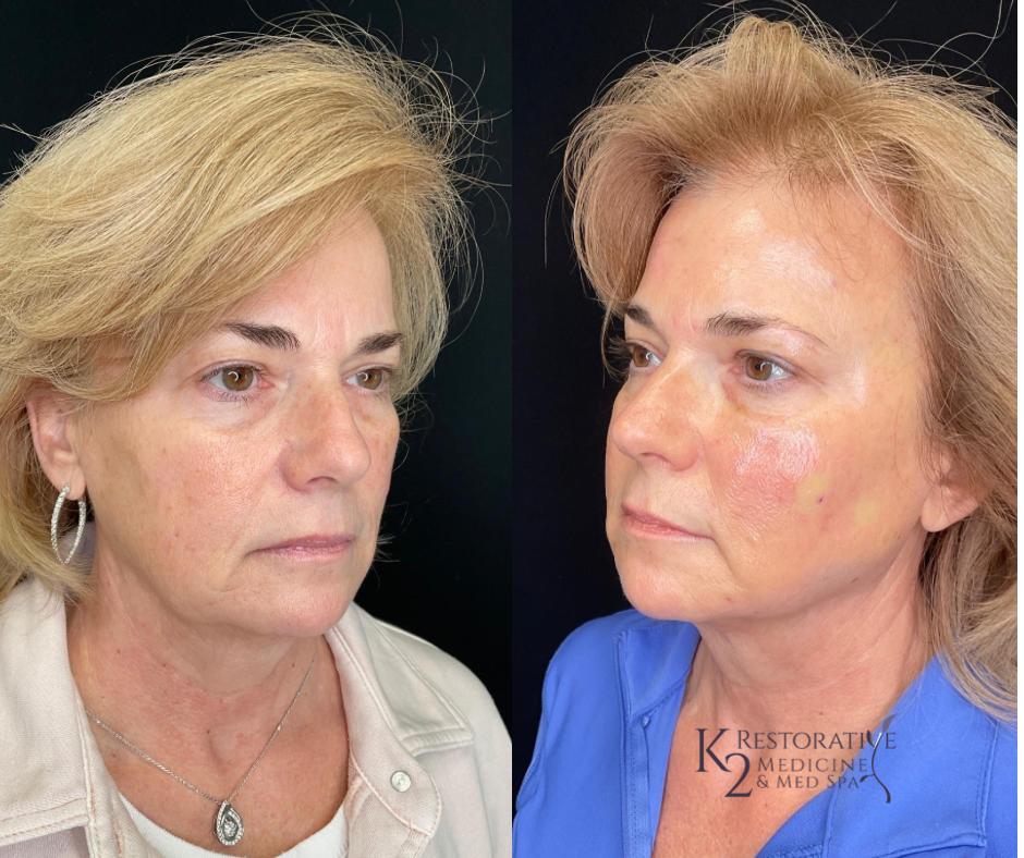 Before and After Sculptra Treatment at K2 medicine and med spa