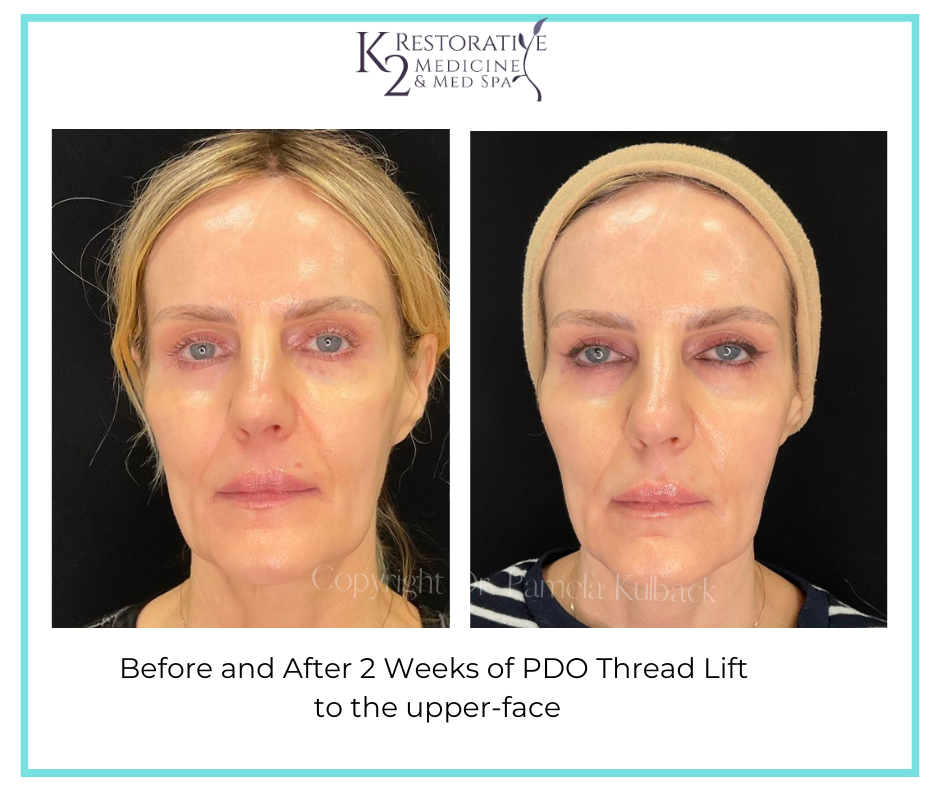 Before and after 2 weeks of PDO thread lift to the upper face at K2 restorative Medicine and Med Spa