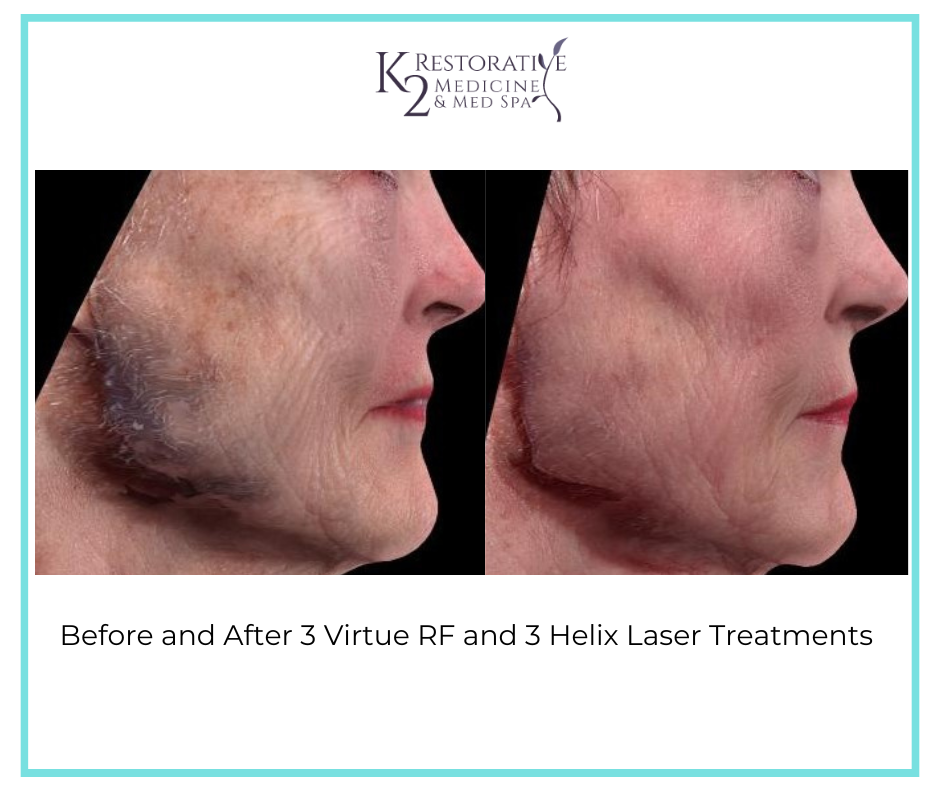 Before and After 3 Virtue RF and Helix Treatments - K2 Restorative Medicine and Med Spa