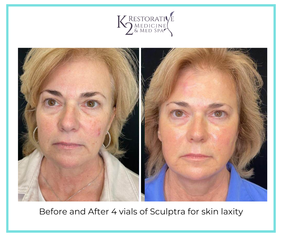 Before and After 4 vials of Sculptra for skin laxity - k2 Restorative Medicine and Med Spa