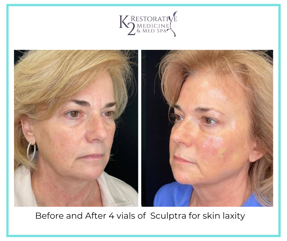 Before and After 4 vials of Sculptra for skin laxity - k2 Restorative Medicine and Med Spa