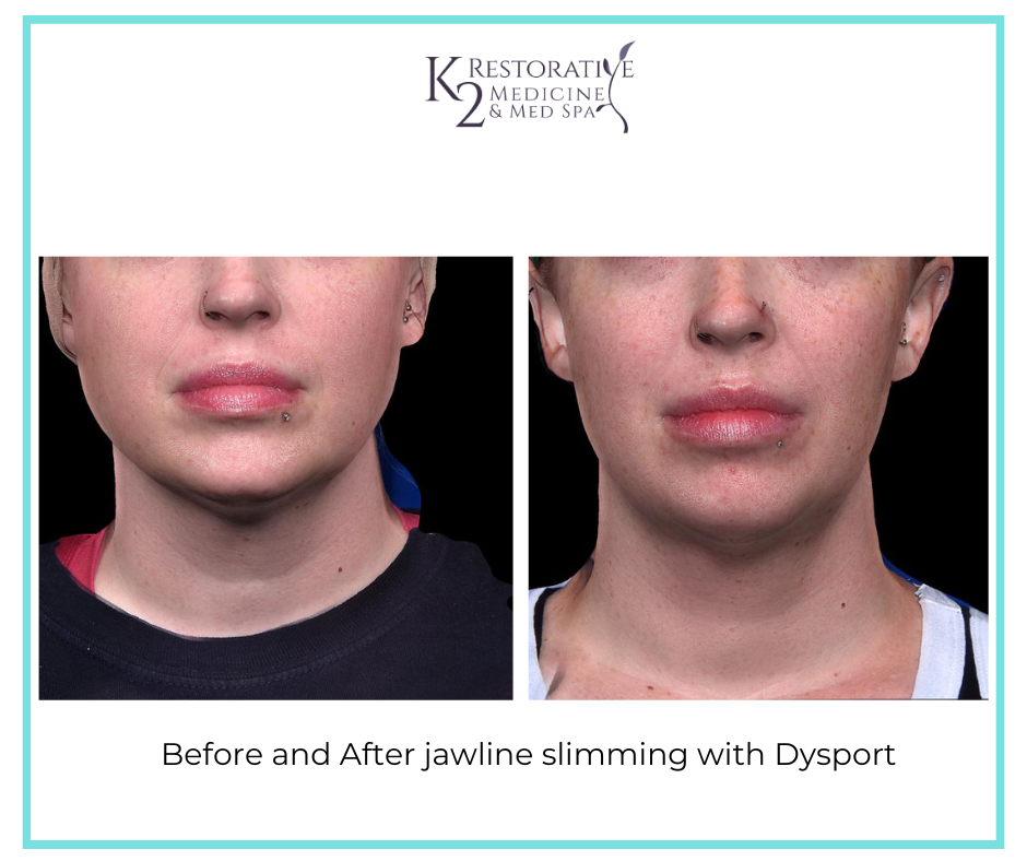 Before and After Jawline slimming with Dysport - K2 Restorative Medicine and Med Spa