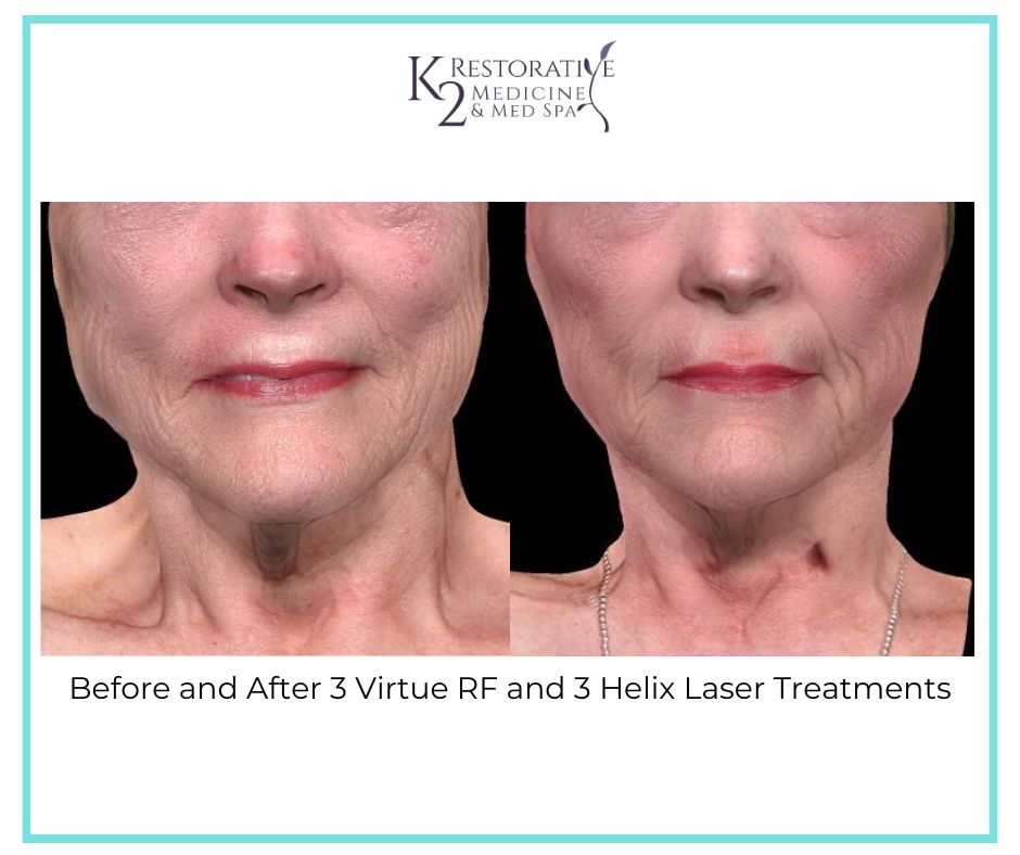 Before and After 3 Virtue RF and Helix Treatments - K2 Restorative Medicine and Med Spa