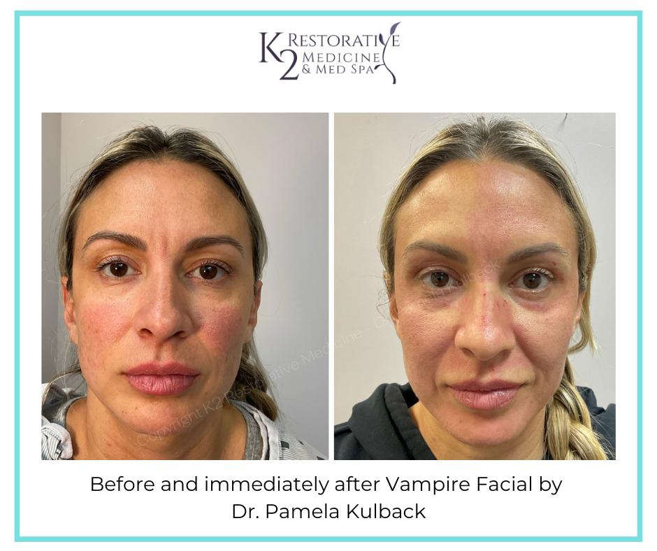 Before and immediately after Vampire Facial by Dr Pamela Kulback