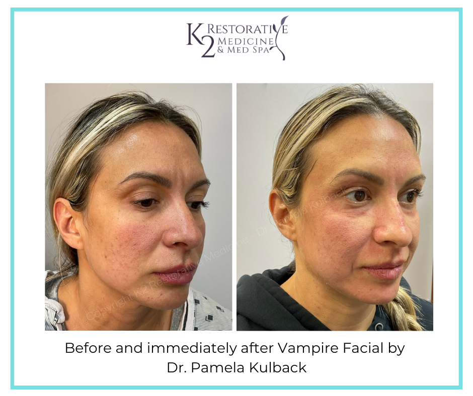 Before and immediately after Vampire Facial by Dr Pamela Kulback