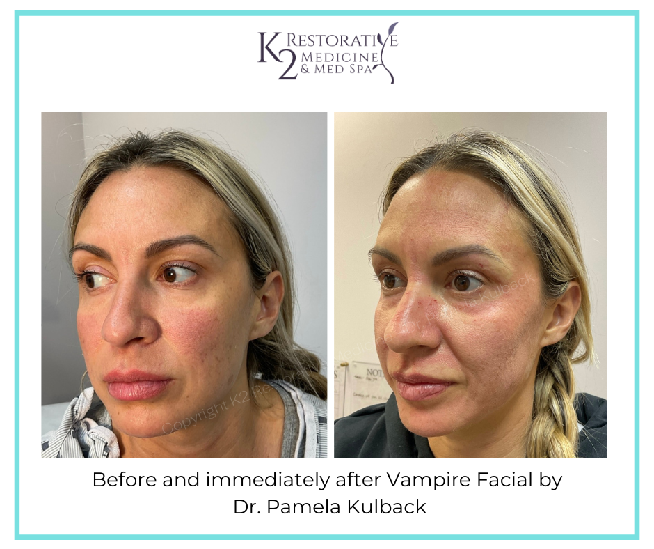 Before and immediately after Vampire Facial by Dr Pamela Kulback