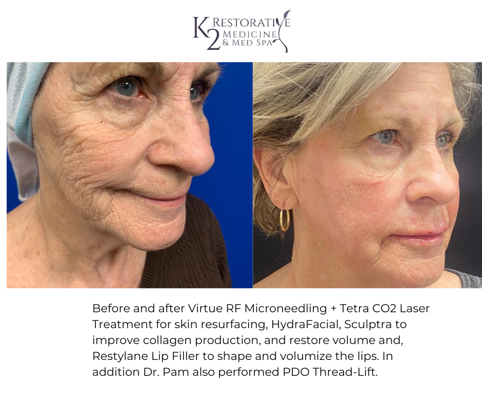 Before and after Virtue RF Microneedling + Tetra CO2 Laser Treatment for skin resurfacing, HydraFacial, Sculptra to improve collagen production and restore volume and, Restylane Lip Filler to shape and volumize the lips