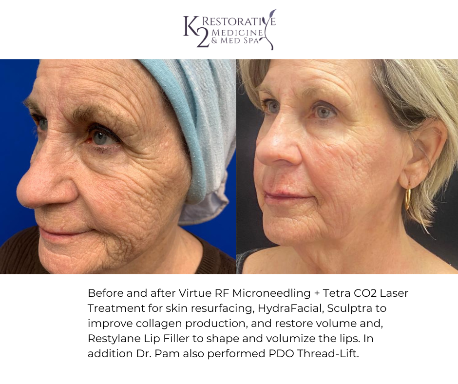 Before and after Virtue RF Microneedling + Tetra CO2 Laser Treatment for skin resurfacing, HydraFacial, Sculptra to improve collagen production and restore volume and, Restylane Lip Filler to shape and volumize the lips