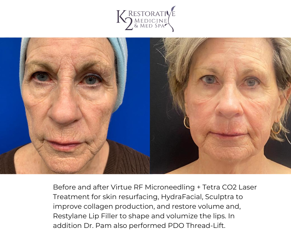 Before and after Virtue RF Microneedling + Tetra CO2 Laser Treatment for skin resurfacing, HydraFacial, Sculptra to improve collagen production and restore volume and, Restylane Lip Filler to shape and volumize the lips