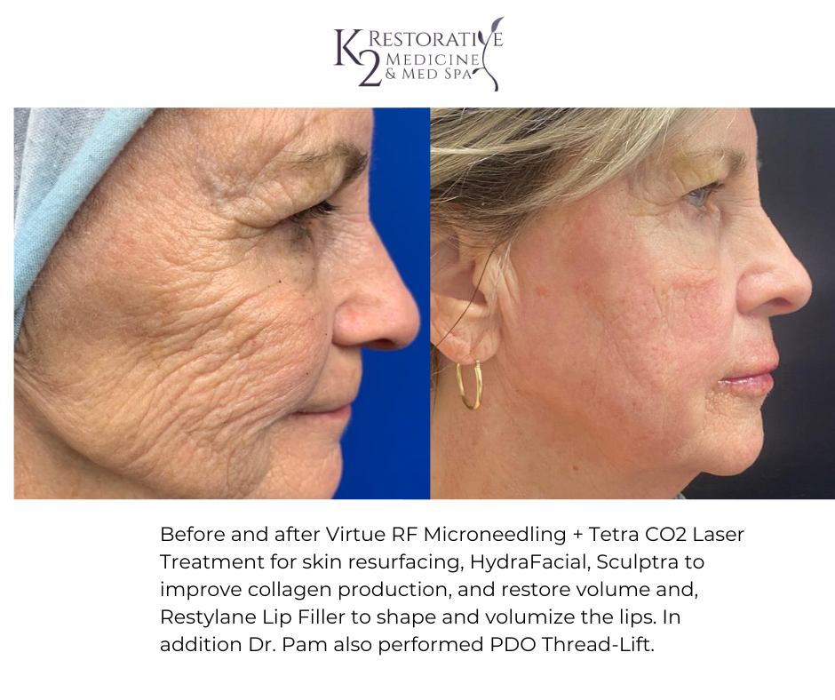 Before and after Virtue RF Microneedling + Tetra CO2 Laser Treatment for skin resurfacing, HydraFacial, Sculptra to improve collagen production and restore volume and, Restylane Lip Filler to shape and volumize the lips