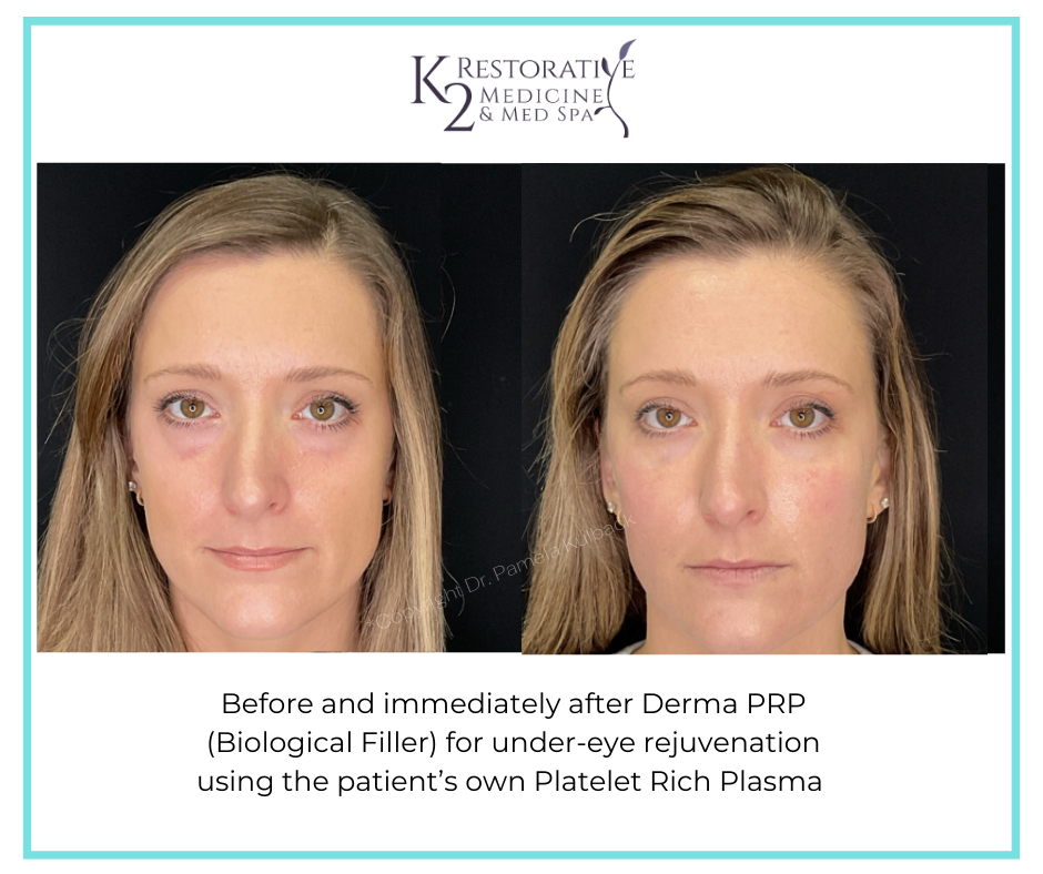 Before and immediately after Derma PRP by Dr Pamela Kulback at K2 Restorative Medicine and Med Spa