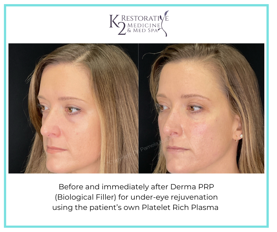 Before and immediately after Derma PRP by Dr Pamela Kulback at K2 Restorative Medicine and Med Spa