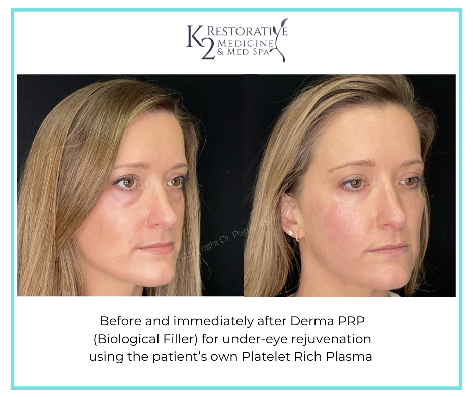 Before and immediately after Derma PRP by Dr Pamela Kulback at K2 Restorative Medicine and Med Spa