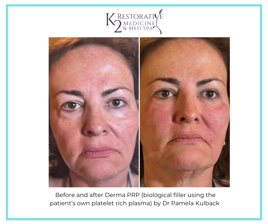 Before and after Derma PRP by Dr Pamela Kulback