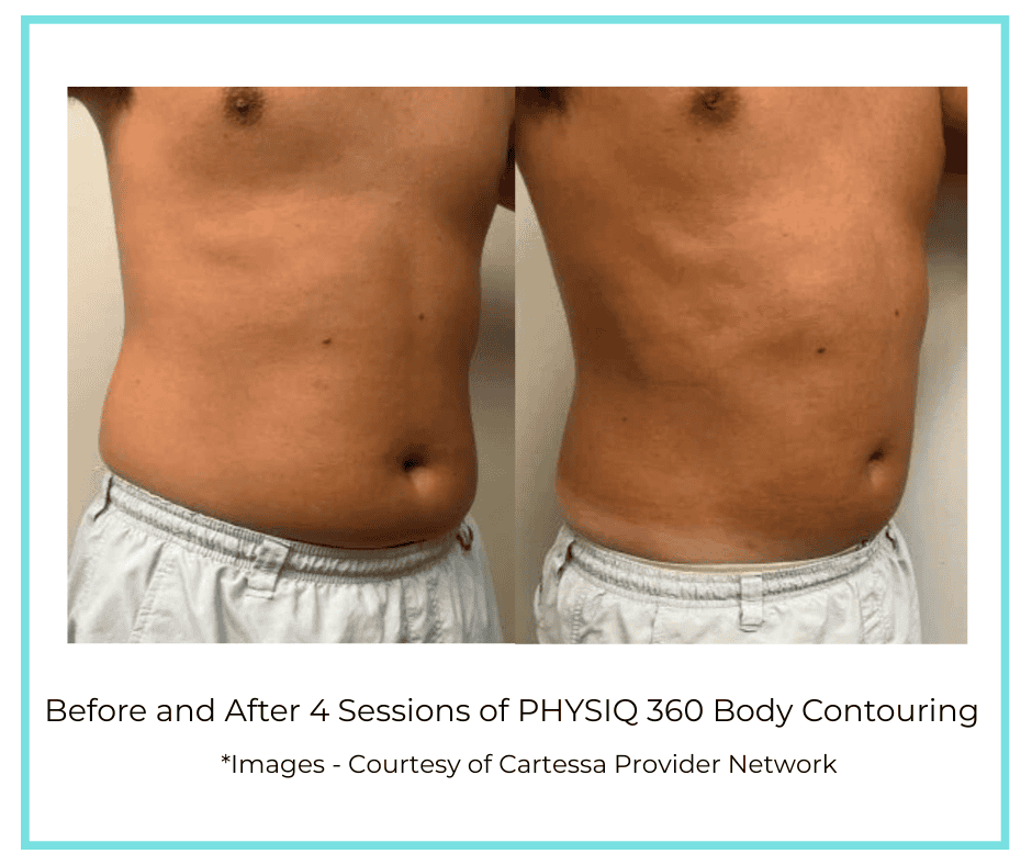 Before and After 4 Sessions of PHYSIQ 360 Body Contouring