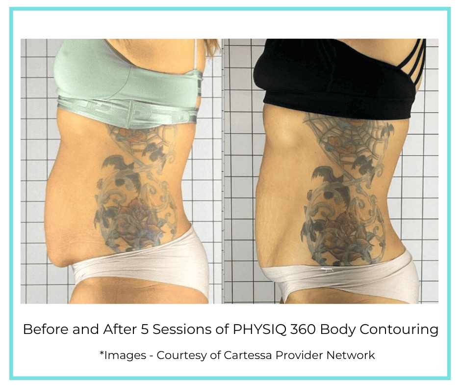 Before and After 5 Sessions of PHYSIQ 360 Body Contouring