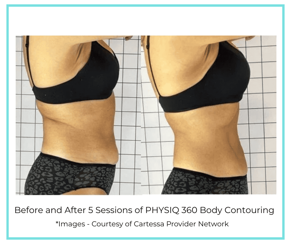 Before and After 5 Sessions of PHYSIQ 360 Body Contouring
