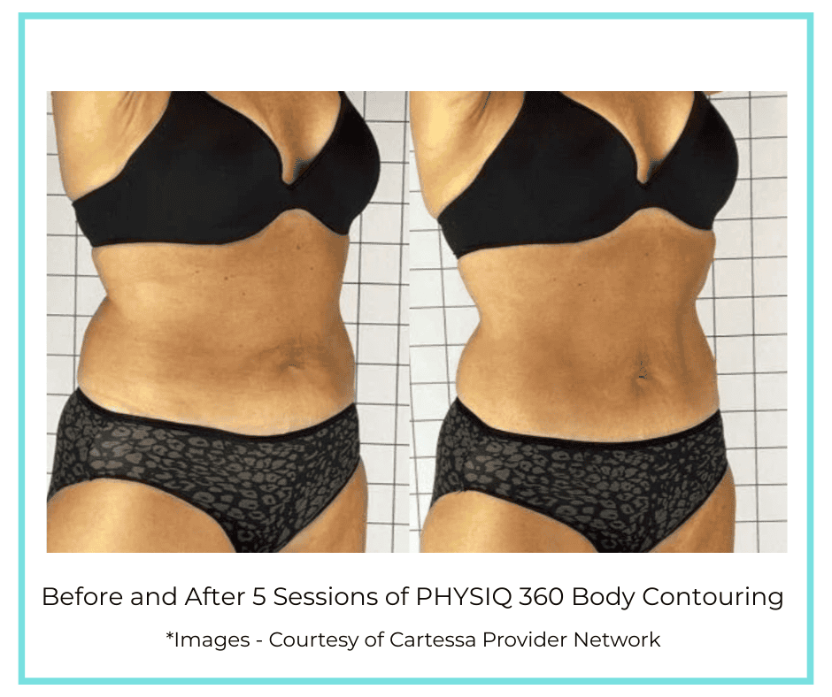 Before and After 5 Sessions of PHYSIQ 360 Body Contouring