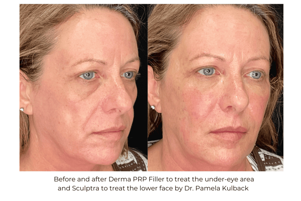 Before and after Derma PRP Filler under-eye area and sculptra to the lower face by Dr. Pamela Kulback